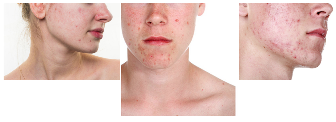 Acne